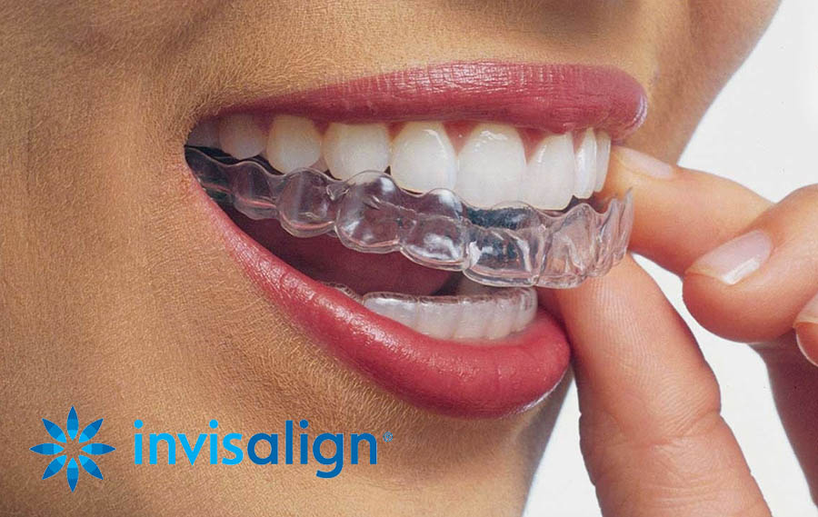 Think Invisalign® for Spring: The Game-Changing Teeth