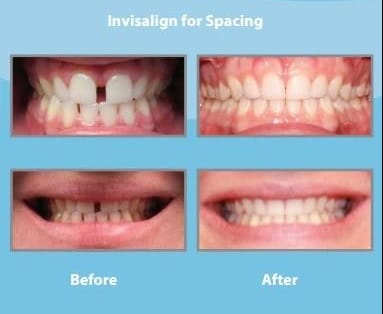 invisalign before and after spacing